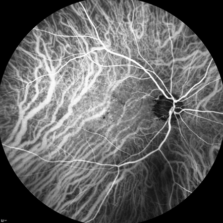 Angiografia amb verd d'indocianina