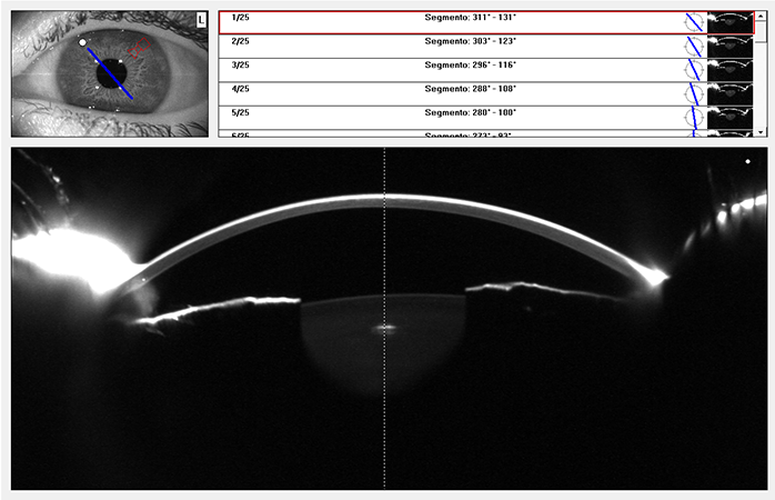 OCT de segment anterior