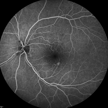 Angiografia 50graus (AGF)