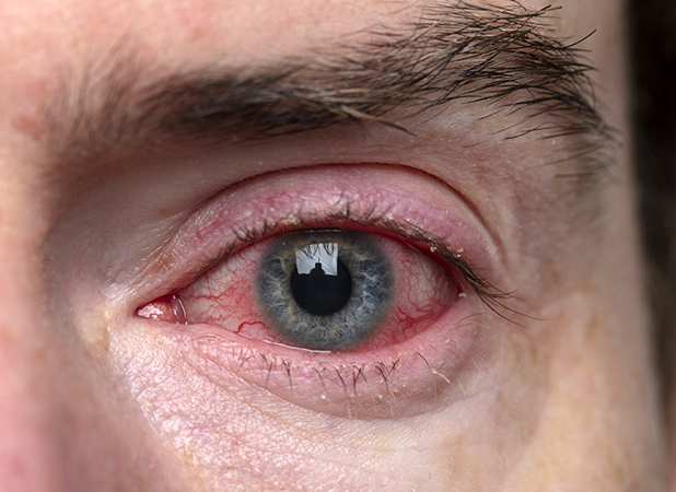 Conjuntivitis