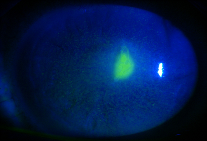 Erosión corneal recurrente