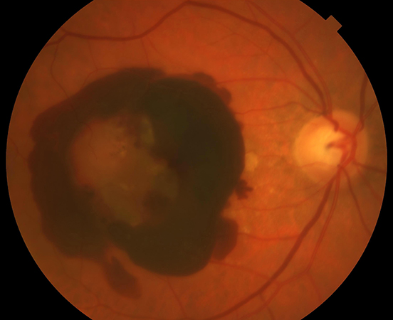 Hemo intraocular i subretiniana