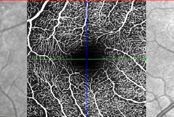 OCT angiogràfica