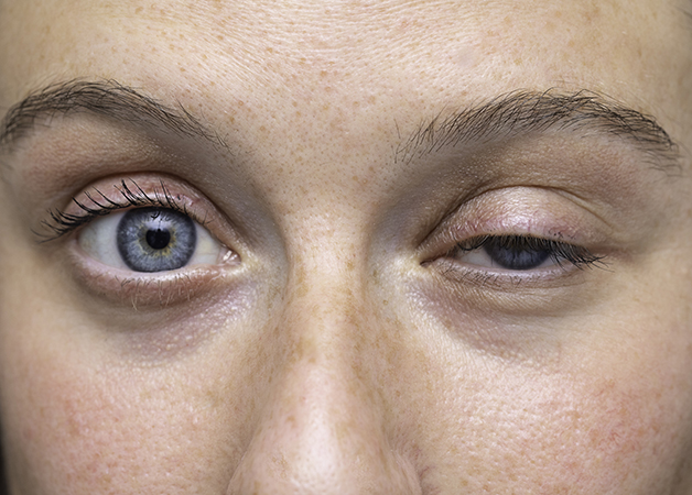 Ptosis palpebral