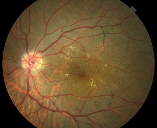 Edema macular