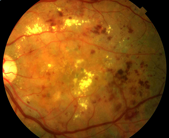 Retinopatia diabètica proliferativa