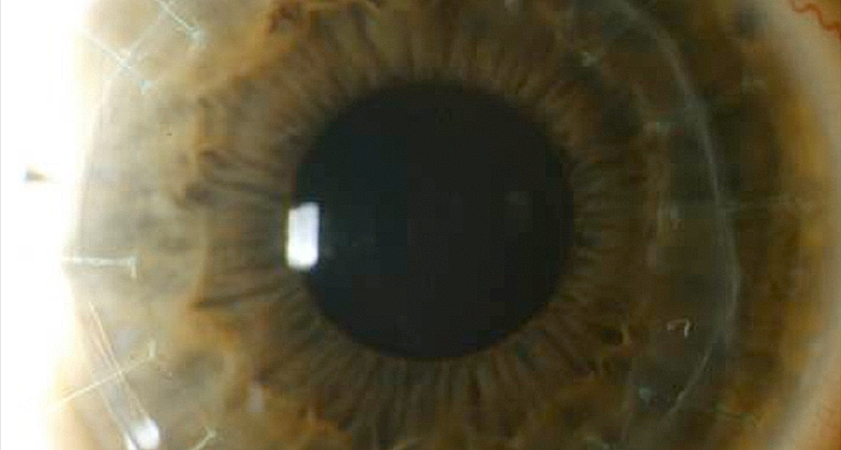Opacidad corneal