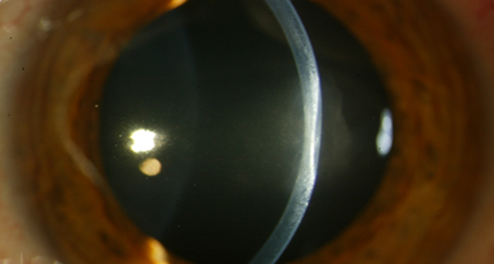 opacitat corneal